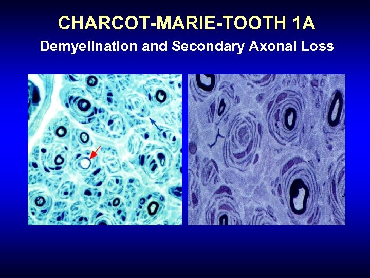 CHARCOT-MARIE-TOOTH 1 A Demyelination and Secondary Axonal Loss 