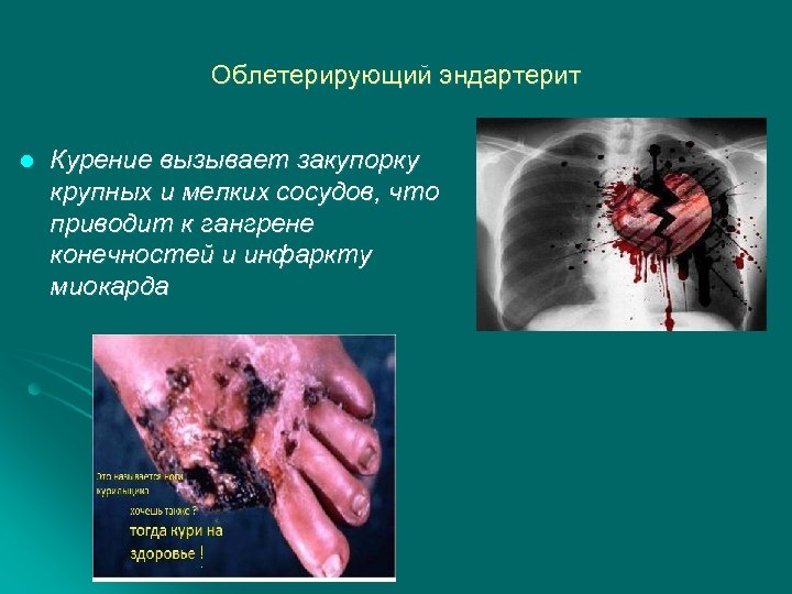 Облетерирующий эндартерит l Курение вызывает закупорку крупных и мелких сосудов, что приводит к гангрене