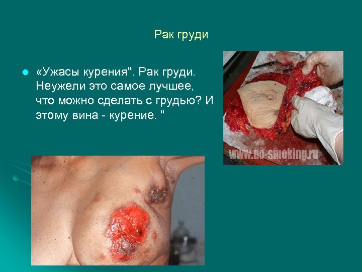 Рак груди l «Ужасы курения