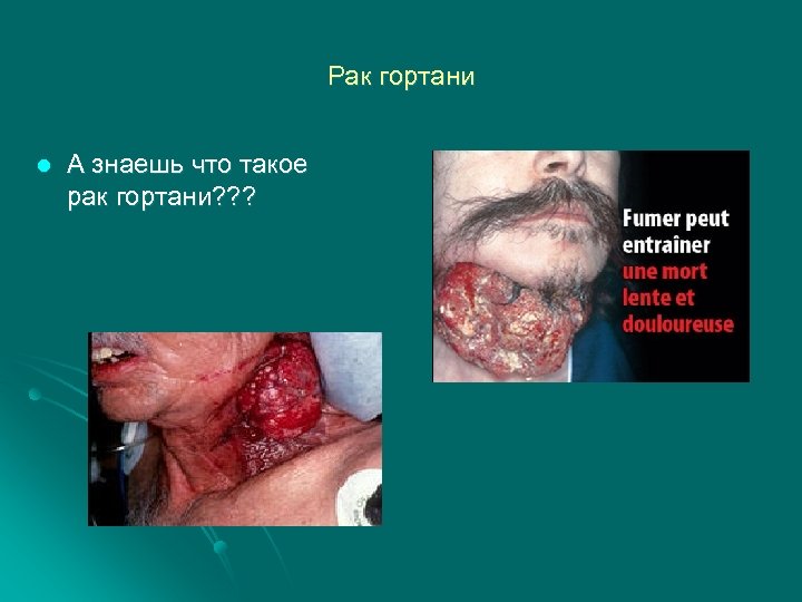 Рак гортани l А знаешь что такое рак гортани? ? ? 