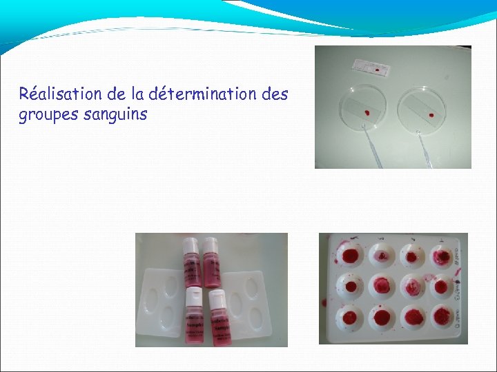 Réalisation de la détermination des groupes sanguins 