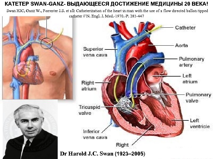 КАТЕТЕР SWAN-GANZ- ВЫДАЮЩЕЕСЯ ДОСТИЖЕНИЕ МЕДИЦИНЫ 20 ВЕКА ! Swan HJC, Ganz W. , Forrester