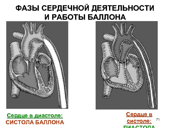 ФАЗЫ СЕРДЕЧНОЙ ДЕЯТЕЛЬНОСТИ И РАБОТЫ БАЛЛОНА Сердце в диастоле: СИСТОЛА БАЛЛОНА Сердце в систоле: