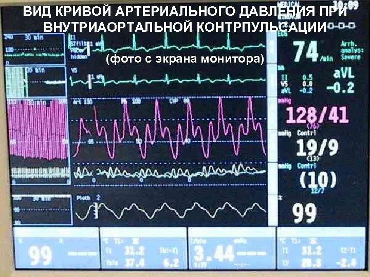 ВИД КРИВОЙ АРТЕРИАЛЬНОГО ДАВЛЕНИЯ ПРИ ВНУТРИАОРТАЛЬНОЙ КОНТРПУЛЬСАЦИИ (фото с экрана монитора) 