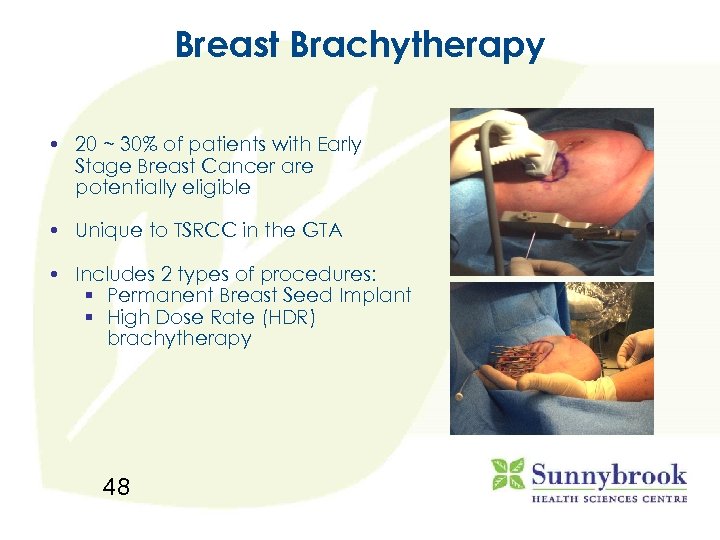 Breast Brachytherapy • 20 ~ 30% of patients with Early Stage Breast Cancer are