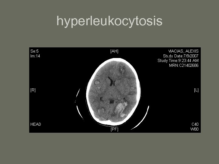 hyperleukocytosis 