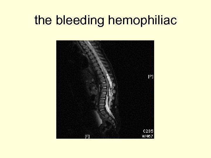 the bleeding hemophiliac 