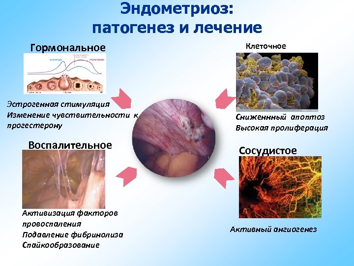 Эндометриоз: патогенез и лечение Гормональное Эстрогенная стимуляция Изменение чувствительности к прогестерону Воспалительное Активизация факторов