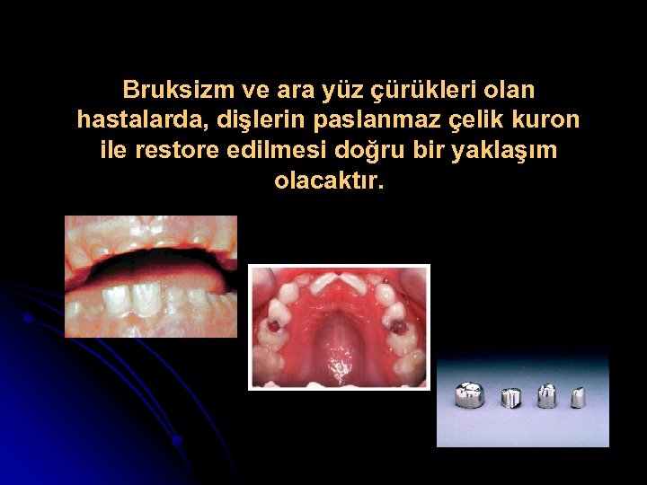 Bruksizm ve ara yüz çürükleri olan hastalarda, dişlerin paslanmaz çelik kuron ile restore edilmesi