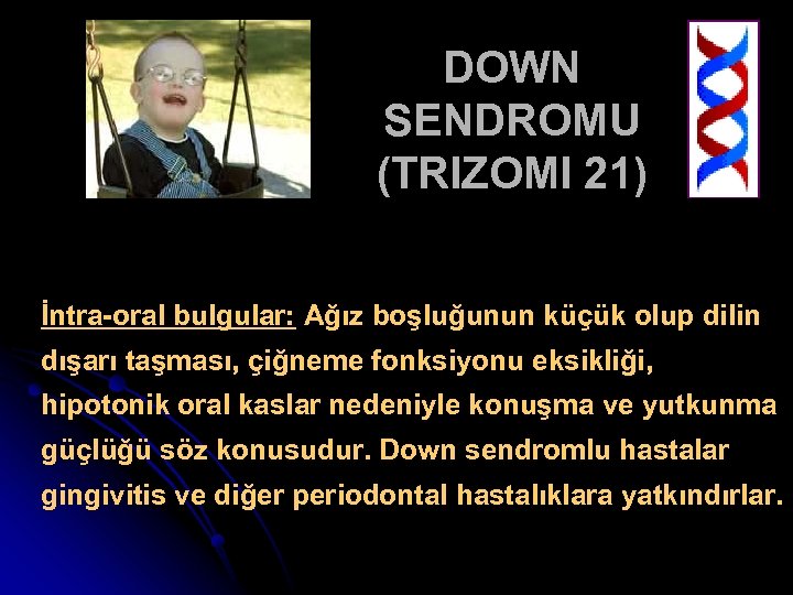 DOWN SENDROMU (TRIZOMI 21) İntra-oral bulgular: Ağız boşluğunun küçük olup dilin dışarı taşması, çiğneme