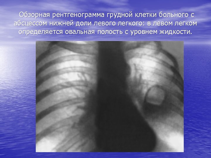 Обзорная рентгенограмма грудной клетки больного с абсцессом нижней доли левого легкого: в левом легком