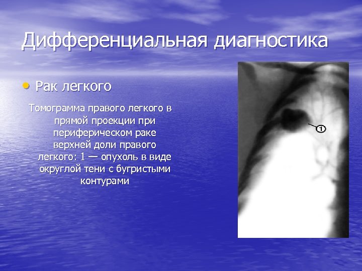 Дифференциальная диагностика • Рак легкого Томограмма правого легкого в прямой проекции при периферическом раке