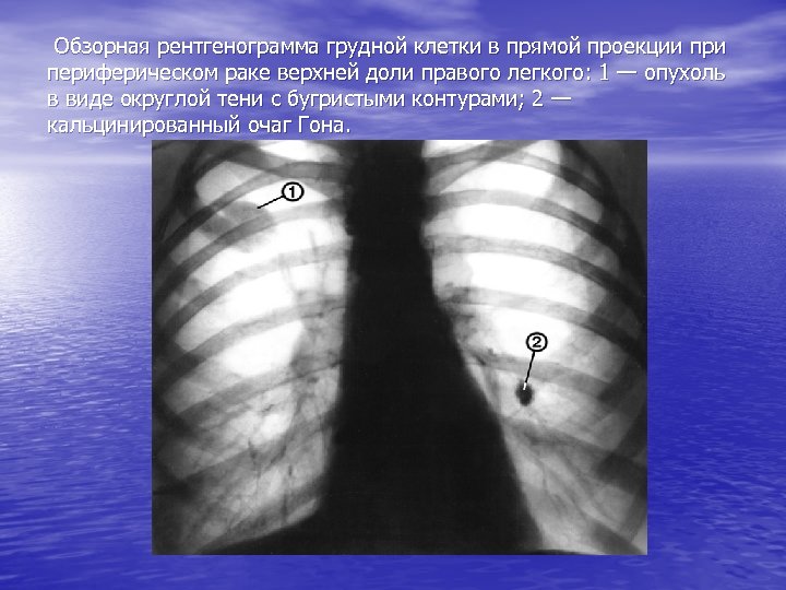 Обзорная рентгенограмма грудной клетки в прямой проекции при периферическом раке верхней доли правого легкого: