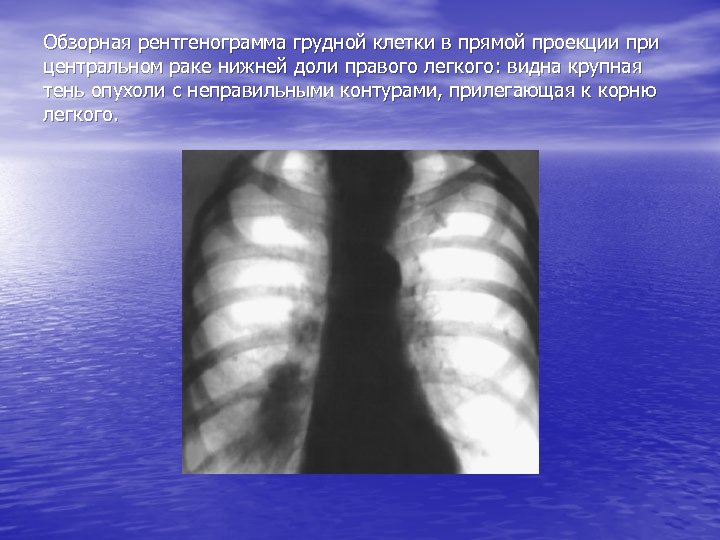 Обзорная рентгенограмма грудной клетки в прямой проекции при центральном раке нижней доли правого легкого: