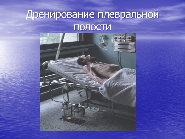 Дренирование плевральной полости 