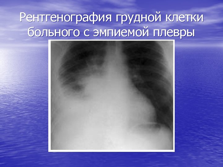 Рентгенография грудной клетки больного с эмпиемой плевры 