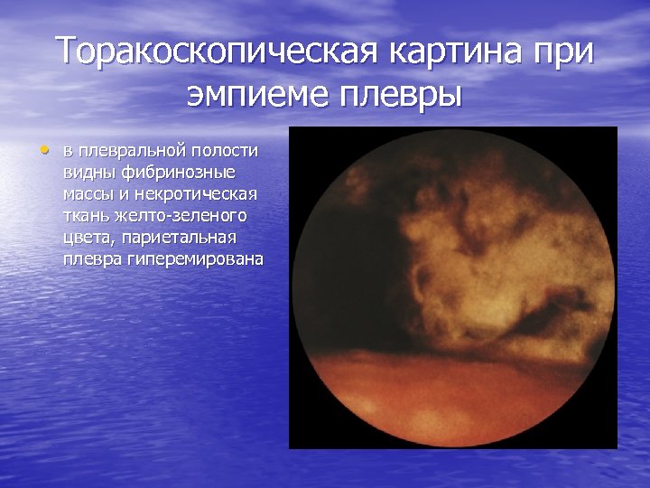 Торакоскопическая картина при эмпиеме плевры • в плевральной полости видны фибринозные массы и некротическая