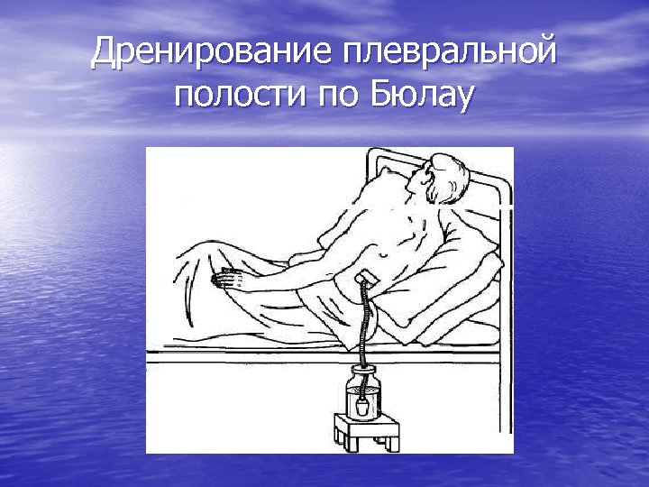 Дренирование плевральной полости по Бюлау 