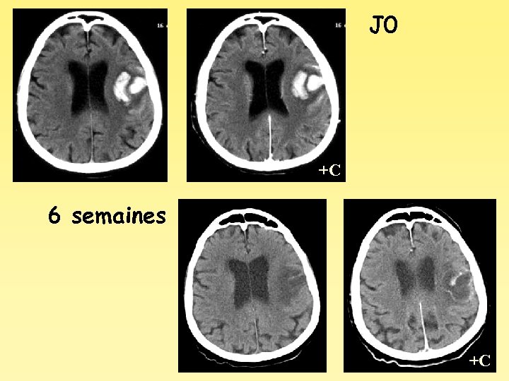 J 0 +C 6 semaines +C 