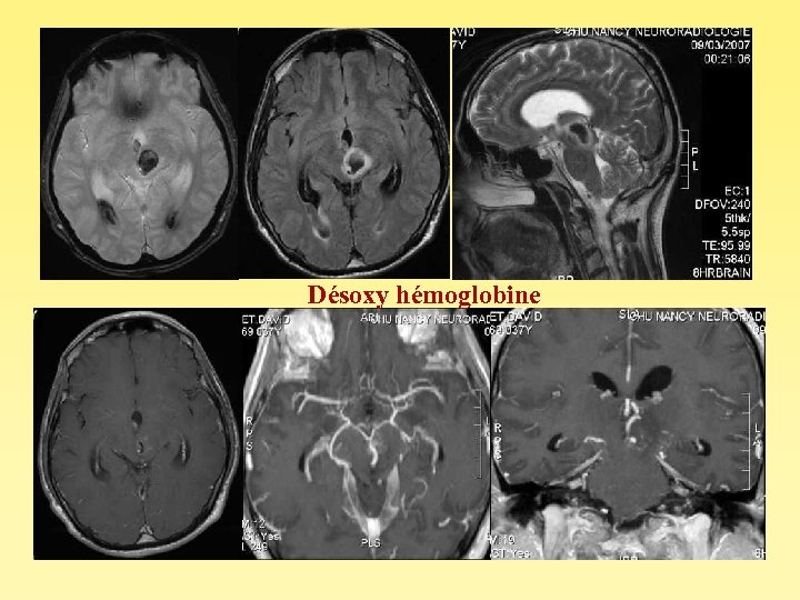 Désoxy hémoglobine 