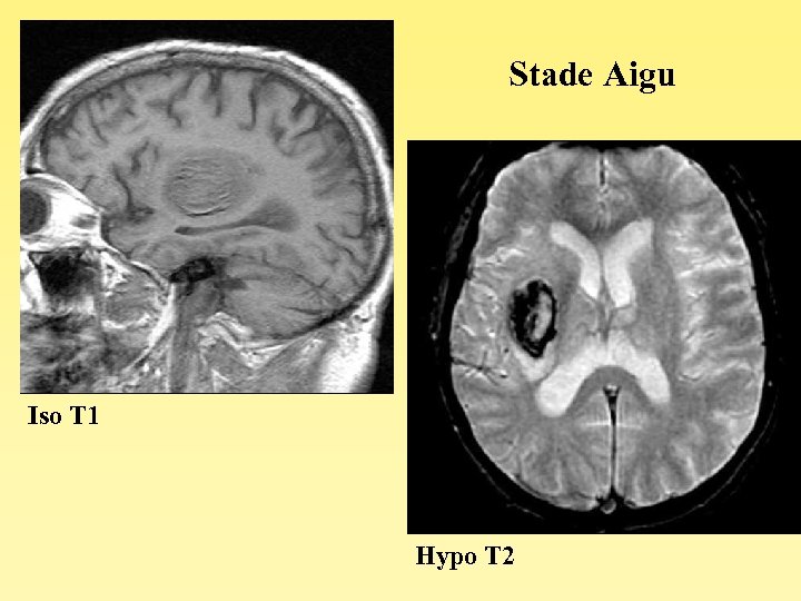 Stade Aigu Iso T 1 Hypo T 2 