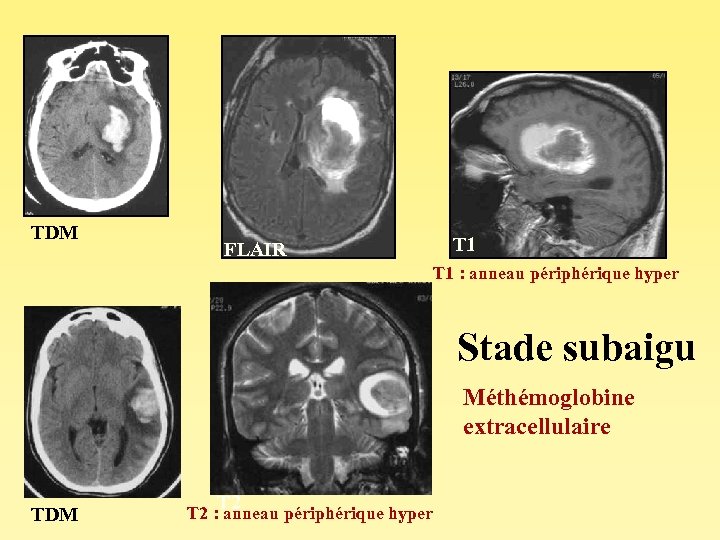 TDM FLAIR T 1 : anneau périphérique hyper Stade subaigu Méthémoglobine extracellulaire TDM T