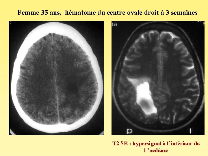 Femme 35 ans, hématome du centre ovale droit à 3 semaines T 2 SE