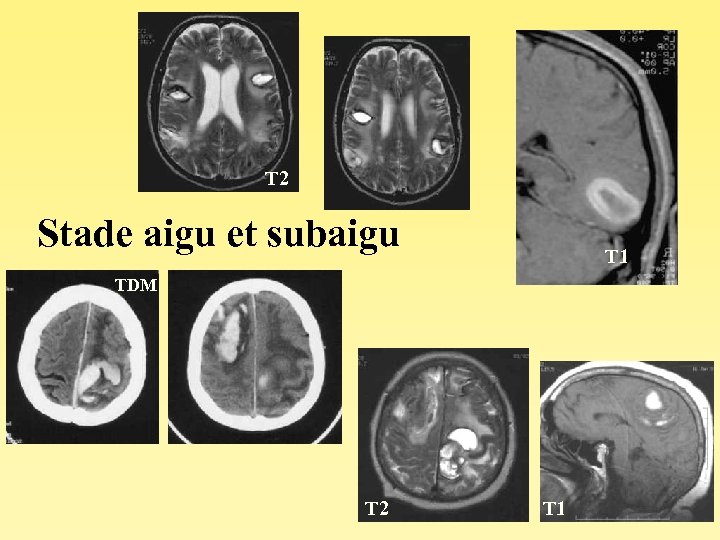 T 2 Stade aigu et subaigu T 1 TDM T 2 T 1 