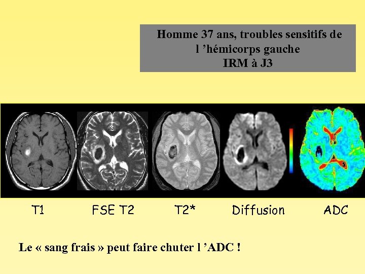  Homme 37 ans, troubles sensitifs de l ’hémicorps gauche IRM à J 3