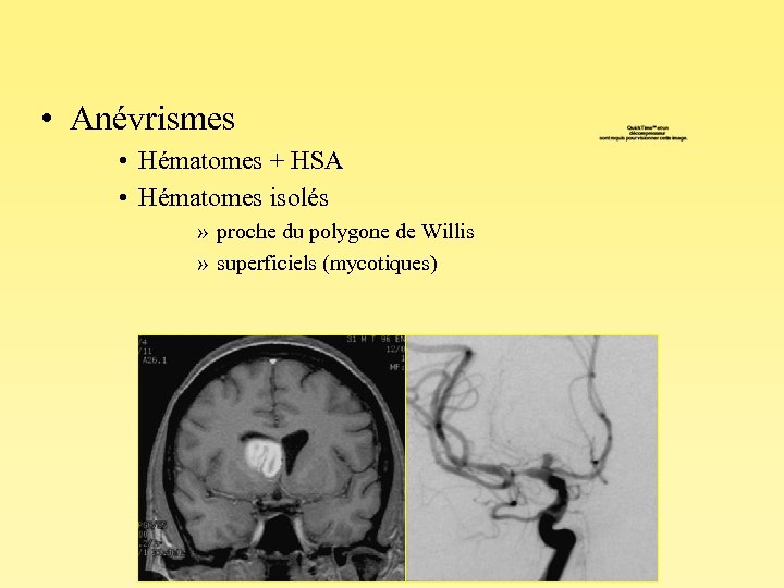  • Anévrismes • Hématomes + HSA • Hématomes isolés » proche du polygone