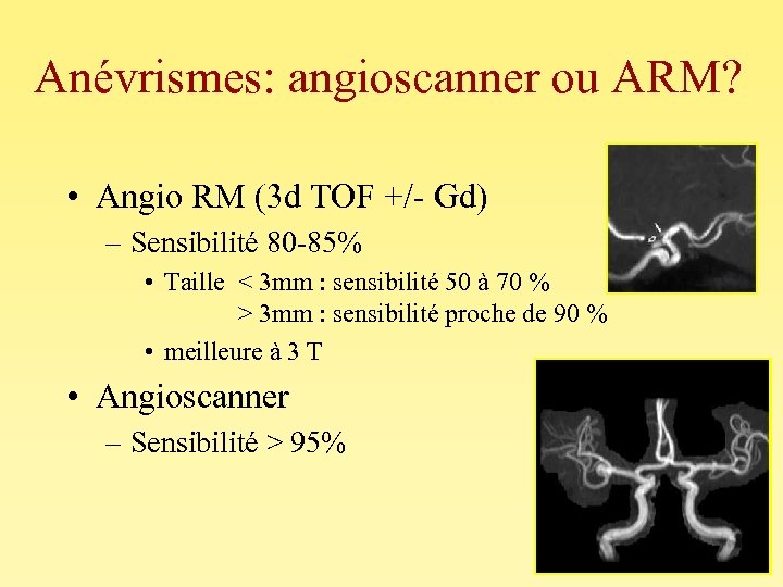 Anévrismes: angioscanner ou ARM? • Angio RM (3 d TOF +/- Gd) – Sensibilité