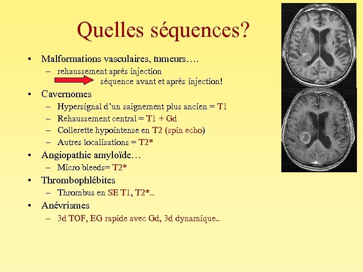 Quelles séquences? • Malformations vasculaires, tumeurs…. – rehaussement après injection séquence avant et après