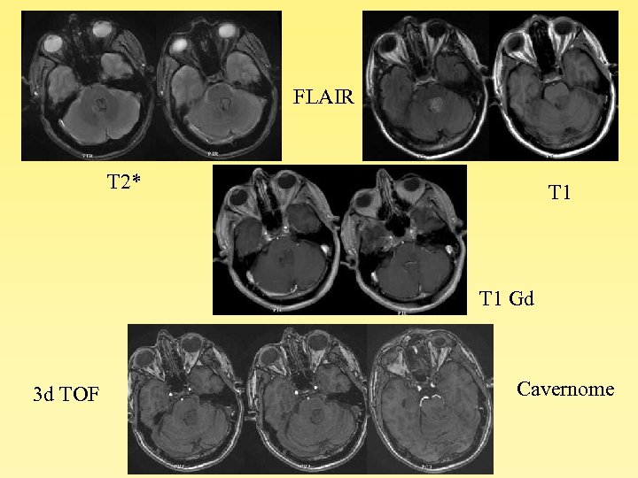 FLAIR T 2* T 1 Gd 3 d TOF Cavernome 