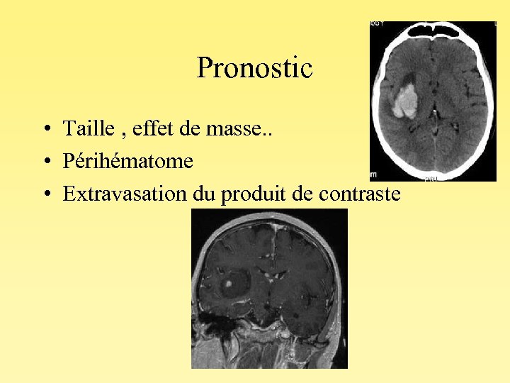 Pronostic • Taille , effet de masse. . • Périhématome • Extravasation du produit