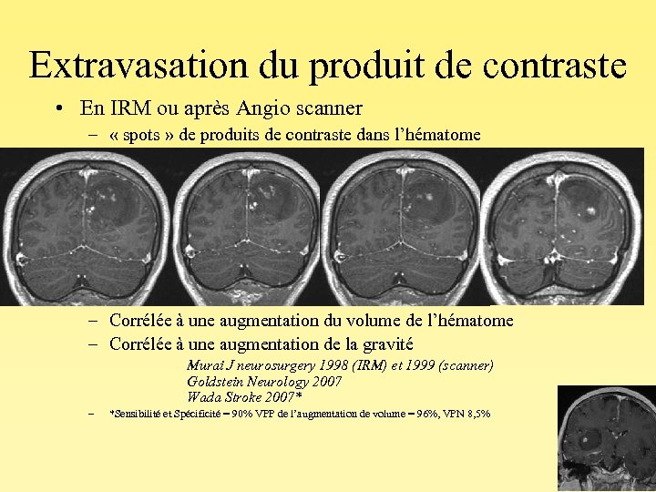 Extravasation du produit de contraste • En IRM ou après Angio scanner – «