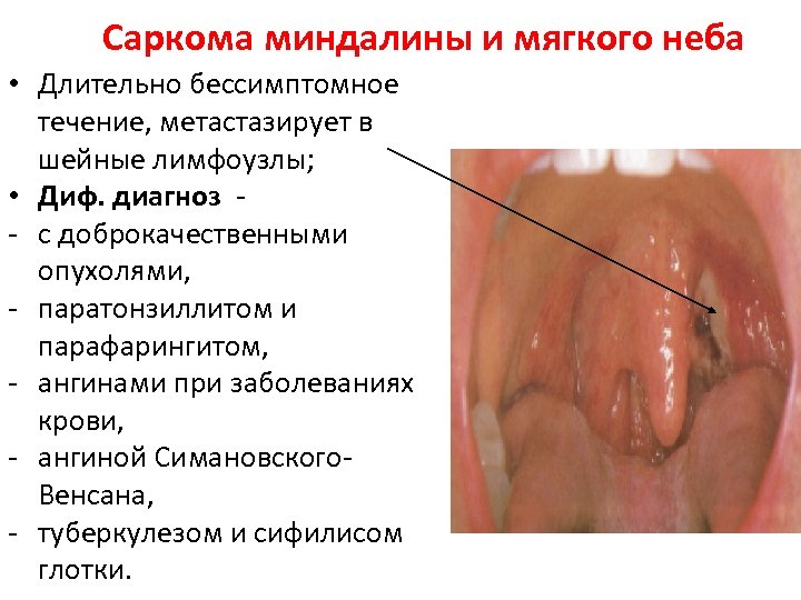 Саркома миндалины и мягкого неба • Длительно бессимптомное течение, метастазирует в шейные лимфоузлы; •