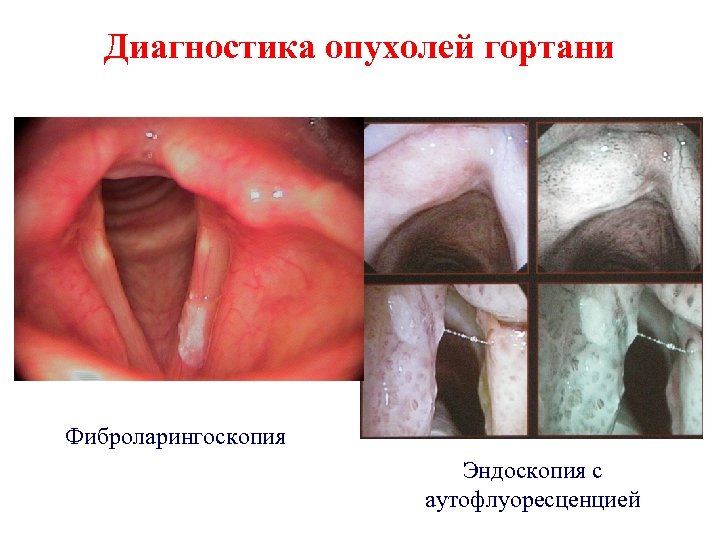 Диагностика опухолей гортани Фиброларингоскопия Эндоскопия с аутофлуоресценцией 