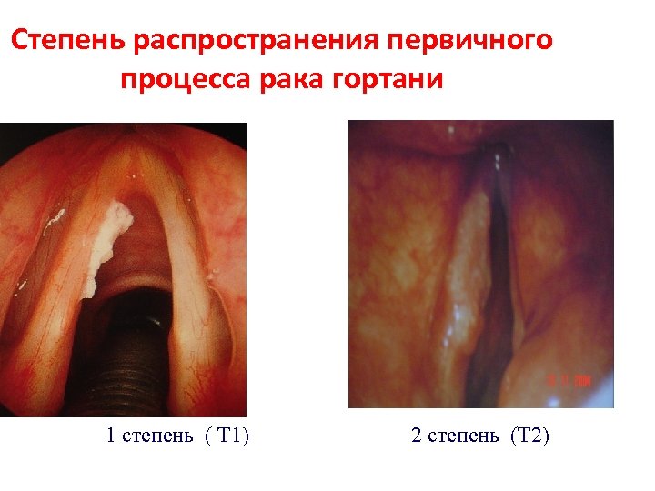 Степень распространения первичного процесса рака гортани 1 степень ( Т 1) 2 степень (Т