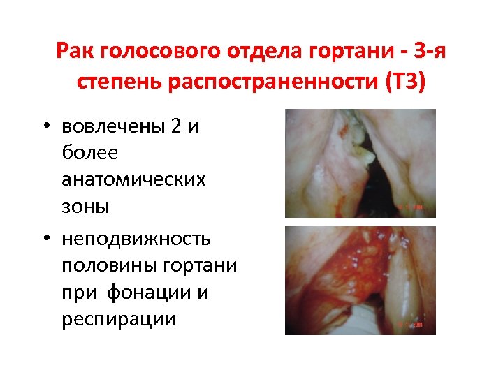 Рак голосового отдела гортани - 3 -я степень распостраненности (Т 3) • вовлечены 2