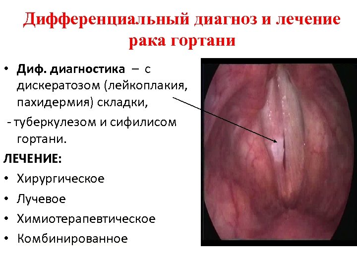 Дифференциальный диагноз и лечение рака гортани • Диф. диагностика – с дискератозом (лейкоплакия, пахидермия)