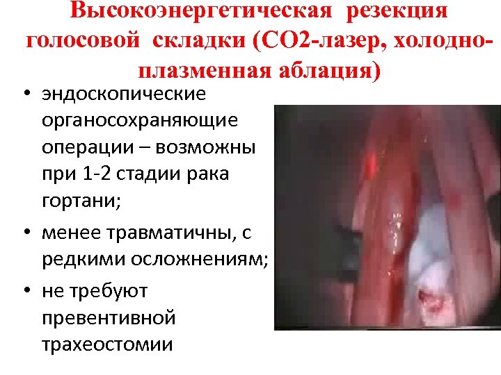 Высокоэнергетическая резекция голосовой складки (СО 2 -лазер, холодноплазменная аблация) • эндоскопические органосохраняющие операции –