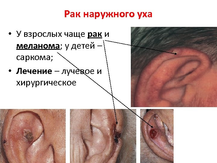 Рак наружного уха • У взрослых чаще рак и меланома; у детей – саркома;
