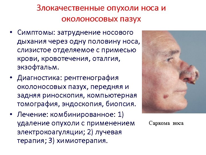 Злокачественные опухоли носа и околоносовых пазух • Симптомы: затруднение носового дыхания через одну половину