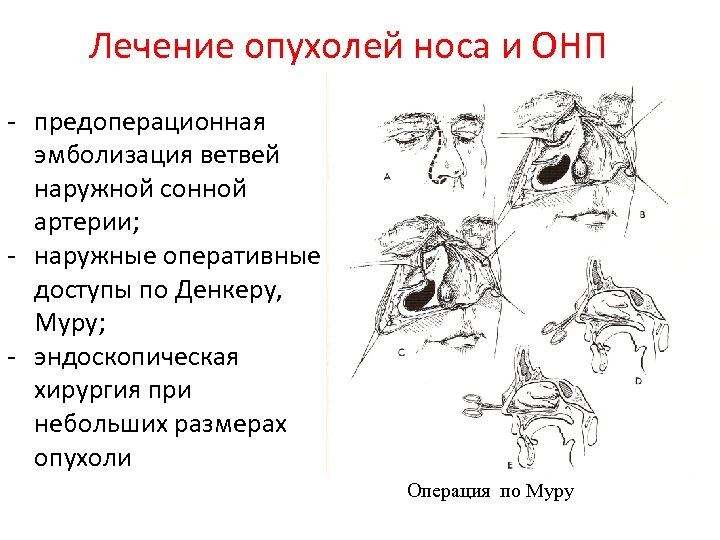 Рак нос руки кот рассказ. Операция по Муру Денкеру. Операция гайморотомии по Денкеру.