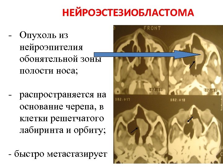 НЕЙРОЭСТЕЗИОБЛАСТОМА - Опухоль из нейроэпителия обонятельной зоны полости носа; - распространяется на основание черепа,
