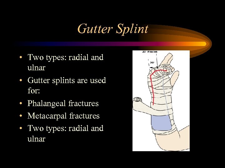 Gutter Splint • Two types: radial and ulnar • Gutter splints are used for: