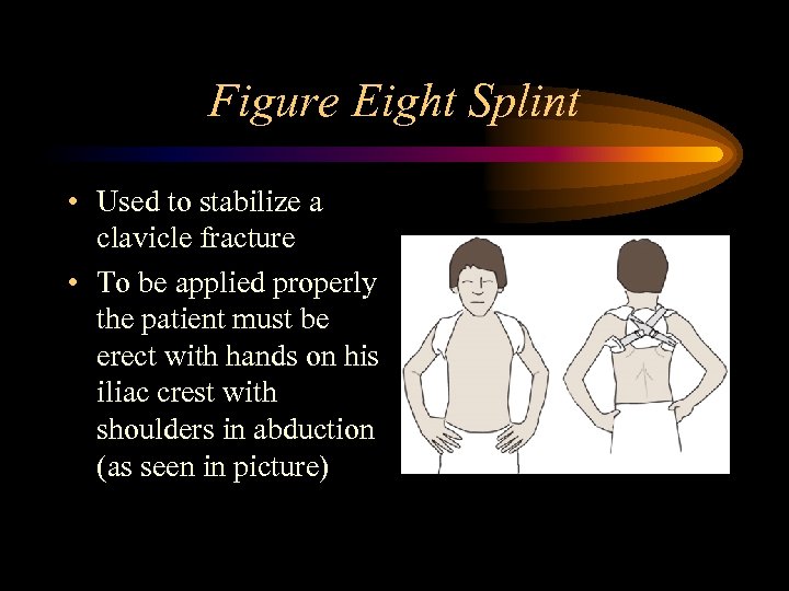Figure Eight Splint • Used to stabilize a clavicle fracture • To be applied