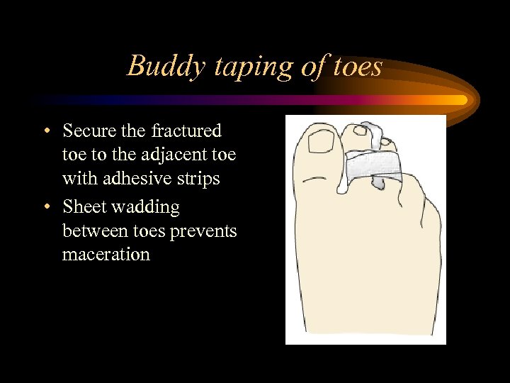 Buddy taping of toes • Secure the fractured toe to the adjacent toe with