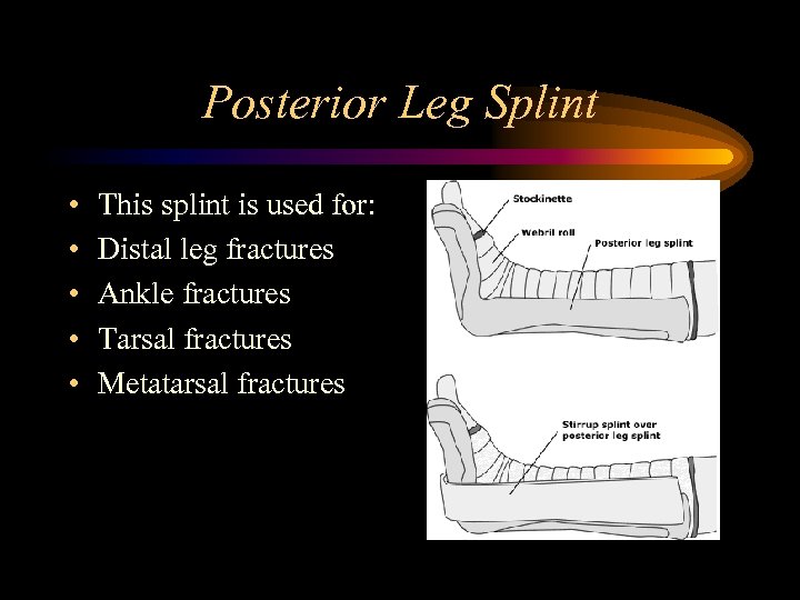 Posterior Leg Splint • • • This splint is used for: Distal leg fractures