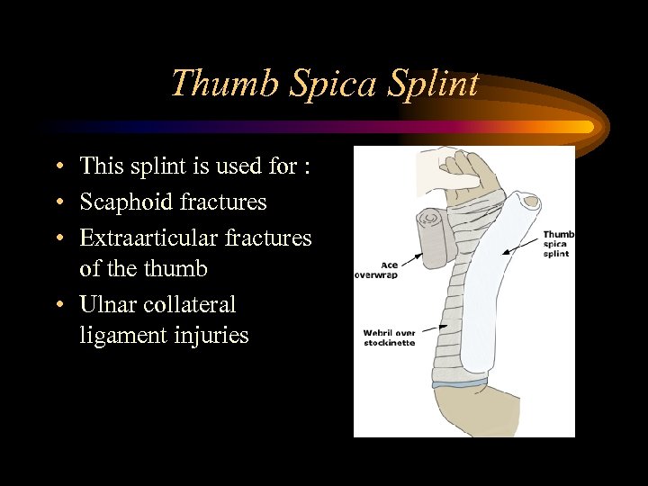 Thumb Spica Splint • This splint is used for : • Scaphoid fractures •